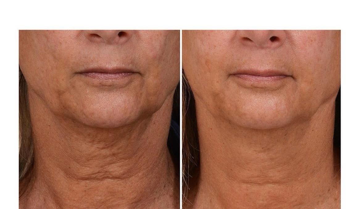 Before and after: jawline and neck firmness
